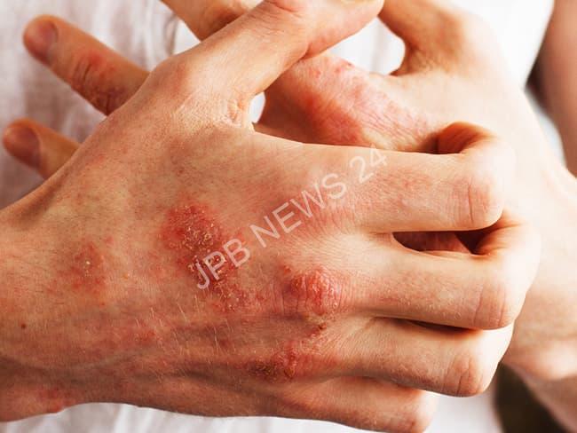 बारिश में बैक्टीरिया और फंगल इंफेक्शन से बचने के उपाय - Ways to avoid bacteria and fungal infection in rain. 